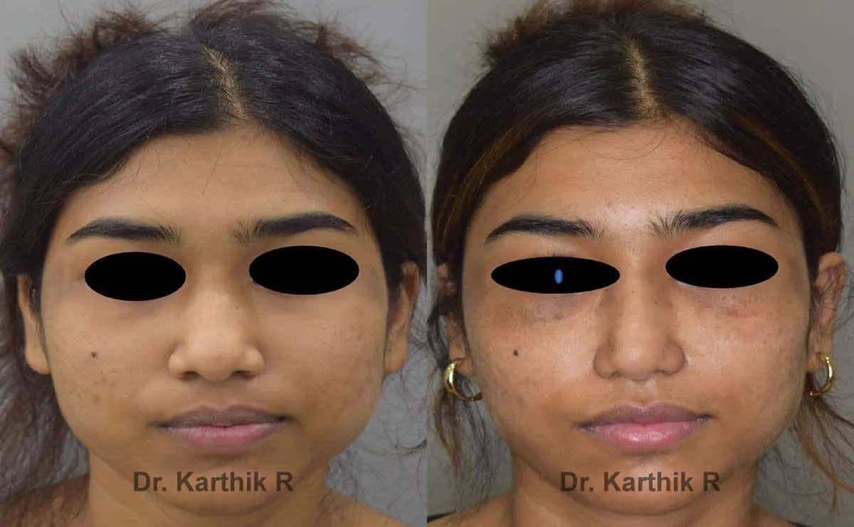 rhinoplasty before and after photo by chennai plastic surgery in india