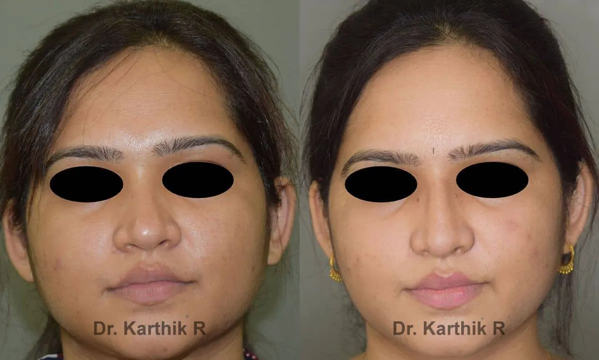 rhinoplasty before and after photo by chennai plastic surgery in india