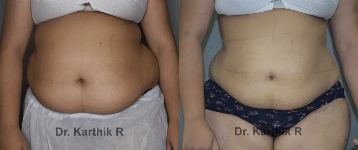 liposuction before and after photo by chennai plastic surgery in india