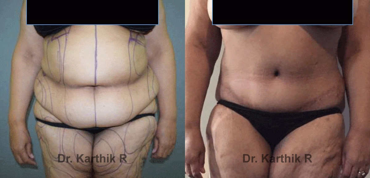tummy tuck before and after photo by chennai plastic surgery in india