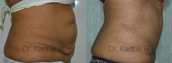 tummy tuck before and after photo by chennai plastic surgery in india