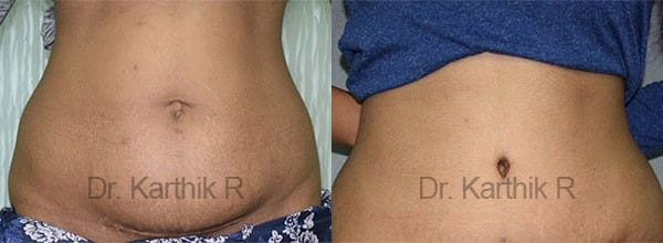 tummy tuck before and after photo by chennai plastic surgery in india