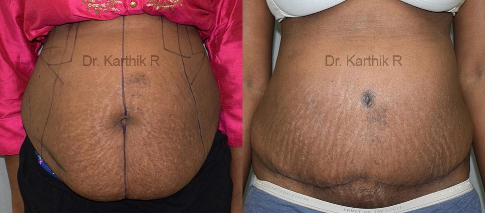 tummy tuck before and after photo by chennai plastic surgery in india