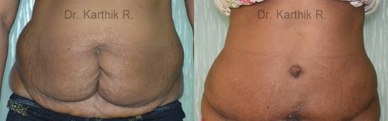 tummy tuck before and after photo by chennai plastic surgery in india