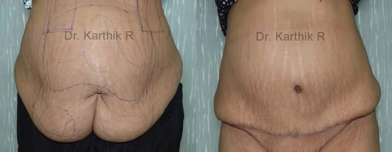 tummy tuck before and after photo by chennai plastic surgery in india