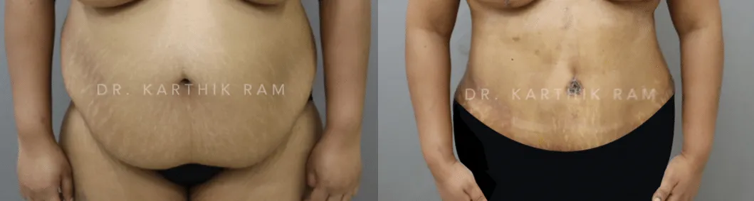tummy tuck before and after photo by chennai plastic surgery in india