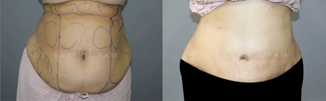 tummy tuck before and after photo by chennai plastic surgery in india