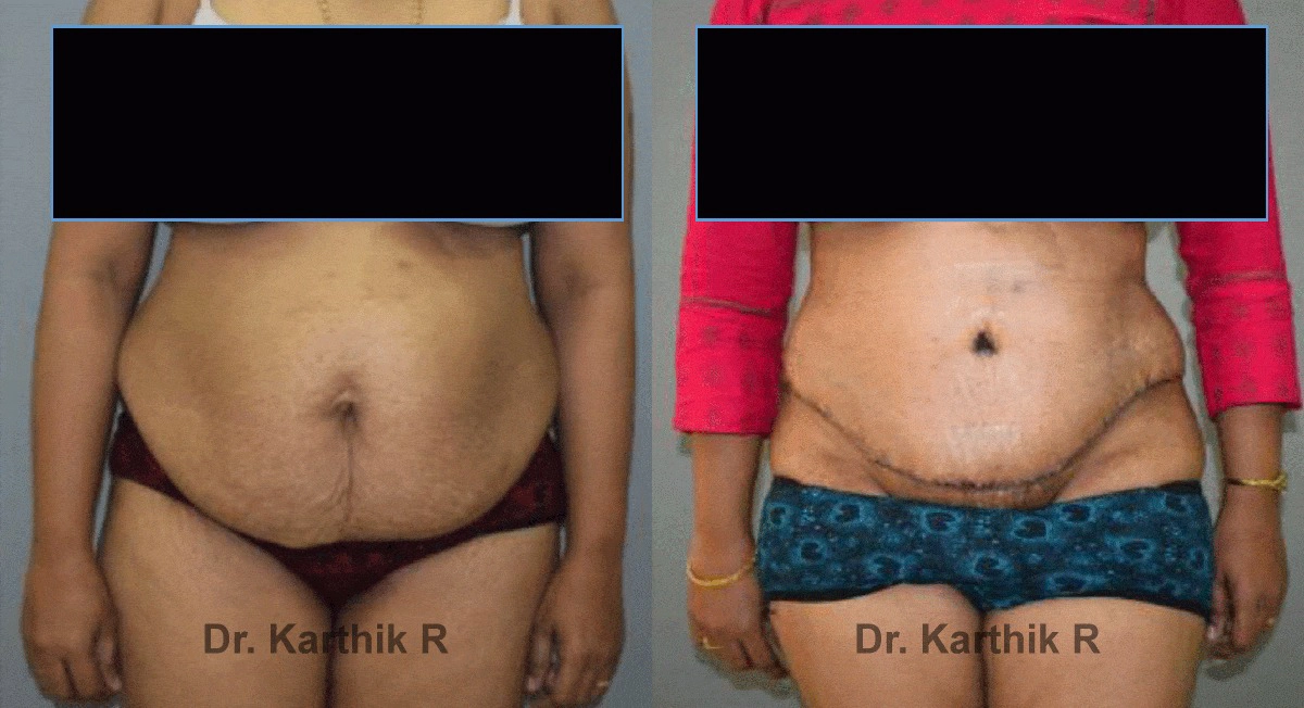 tummy tuck before and after photo by chennai plastic surgery in india