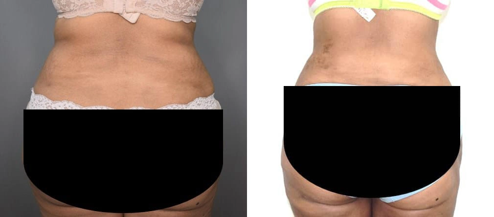 vaser liposuction before and after photo by chennai plastic surgery in india