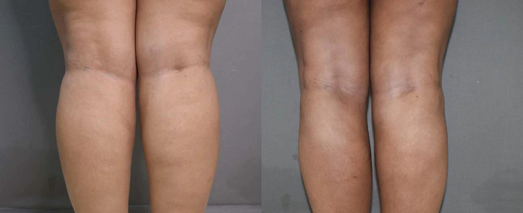 vaser liposuction before and after photo by chennai plastic surgery in india