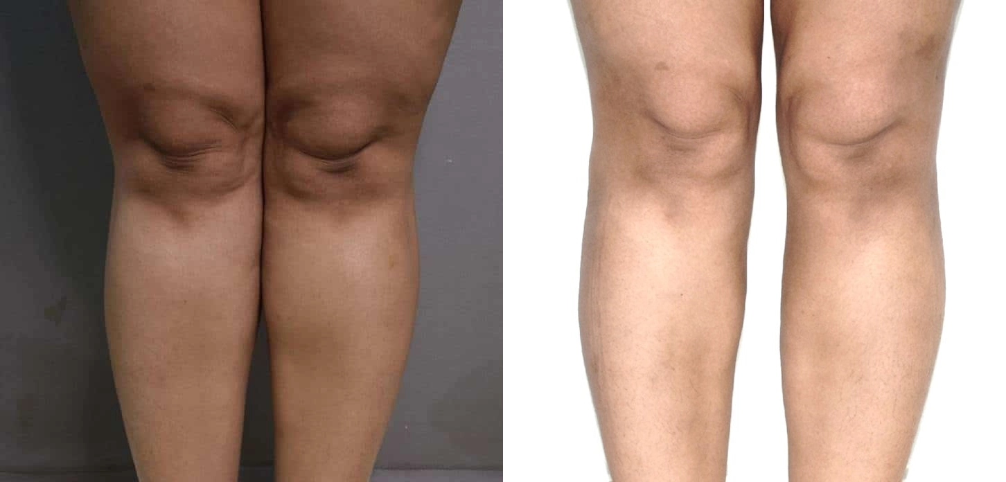 vaser liposuction before and after photo by chennai plastic surgery in india