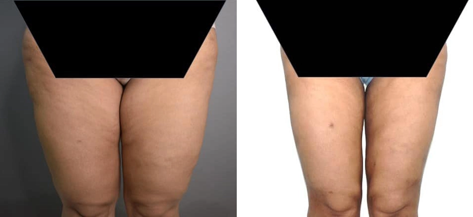 vaser liposuction before and after photo by chennai plastic surgery in india