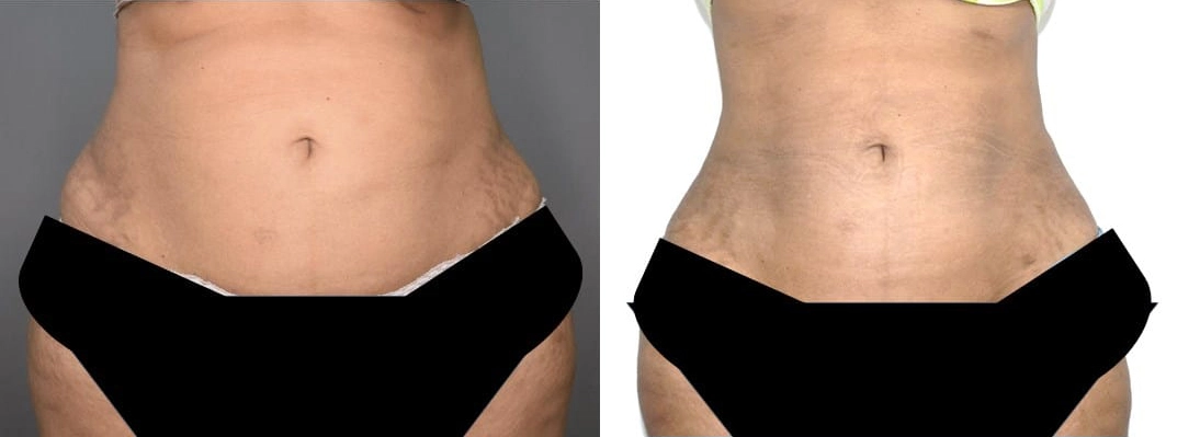 vaser liposuction before and after photo by chennai plastic surgery in india