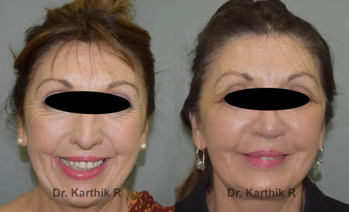 facelift before and after photo by chennai plastic surgery in india