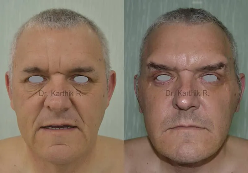 facelift before and after photo by chennai plastic surgery in india