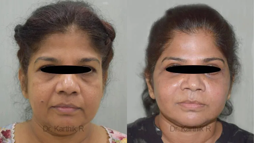 facelift before and after photo by chennai plastic surgery in india