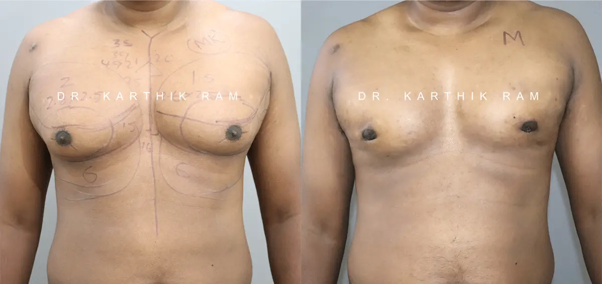 gynecomastia before and after photo by chennai plastic surgery in india