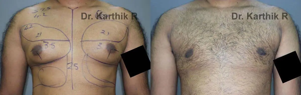 gynecomastia before and after photo by chennai plastic surgery in india