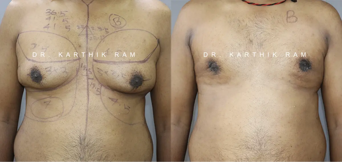 gynecomastia before and after photo by chennai plastic surgery in india