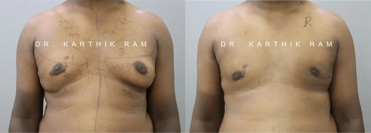 gynecomastia before and after photo by chennai plastic surgery in india