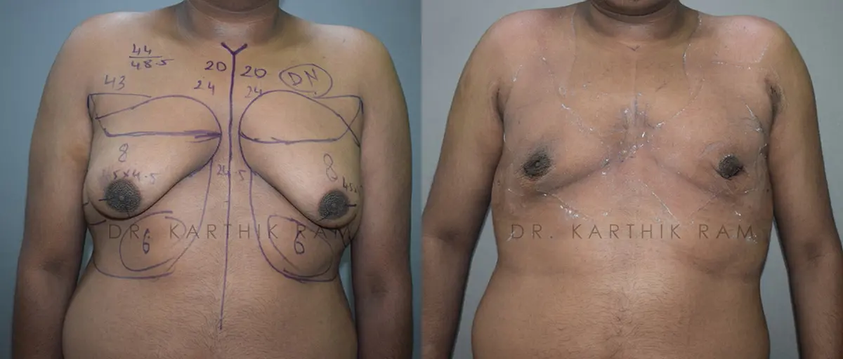 gynecomastia before and after photo by chennai plastic surgery in india