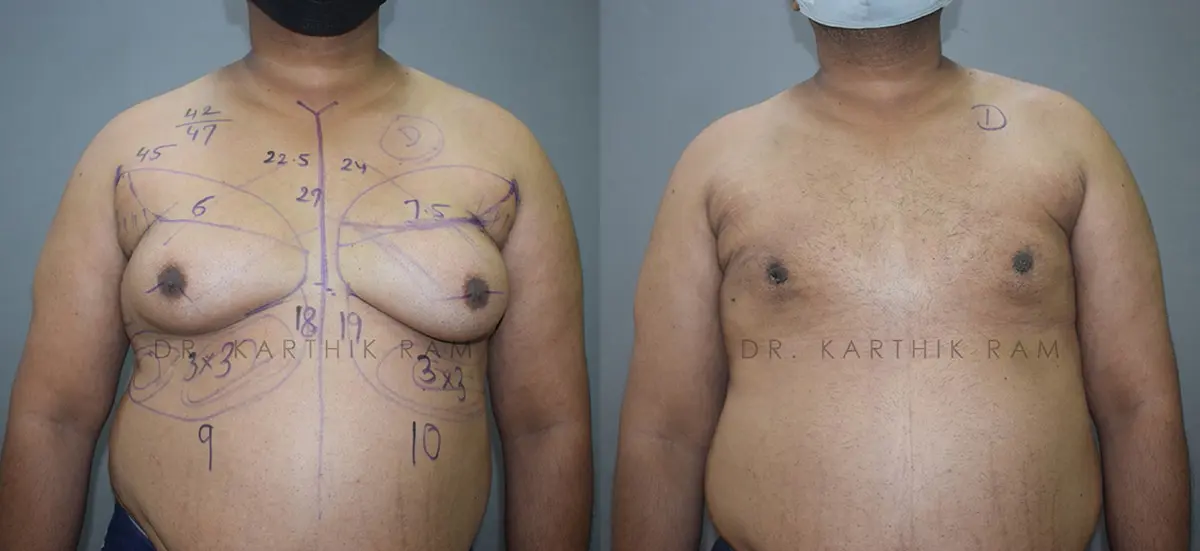 gynecomastia before and after photo by chennai plastic surgery in india