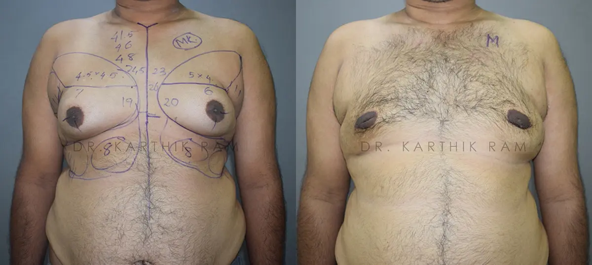 gynecomastia before and after photo by chennai plastic surgery in india