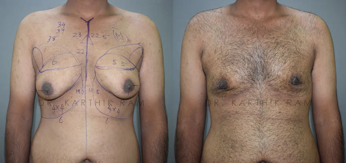 gynecomastia before and after photo by chennai plastic surgery in india