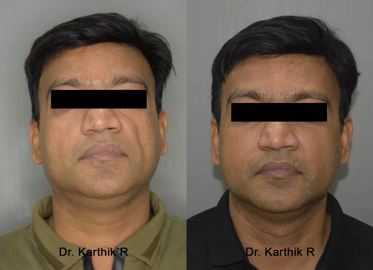 fat graft fat fill fat transfer before and after photo by chennai plastic surgery in india