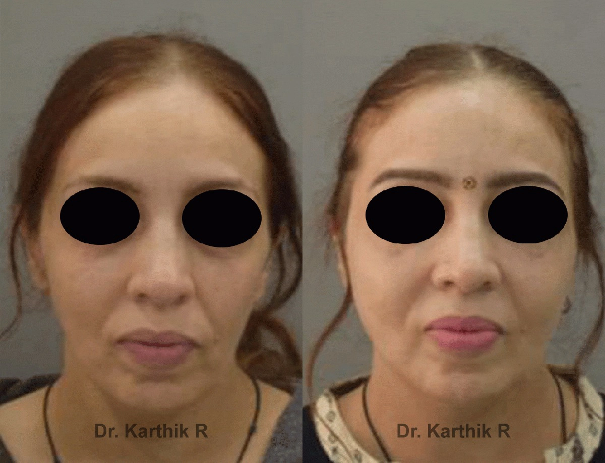 fat graft fat fill fat transfer before and after photo by chennai plastic surgery in india