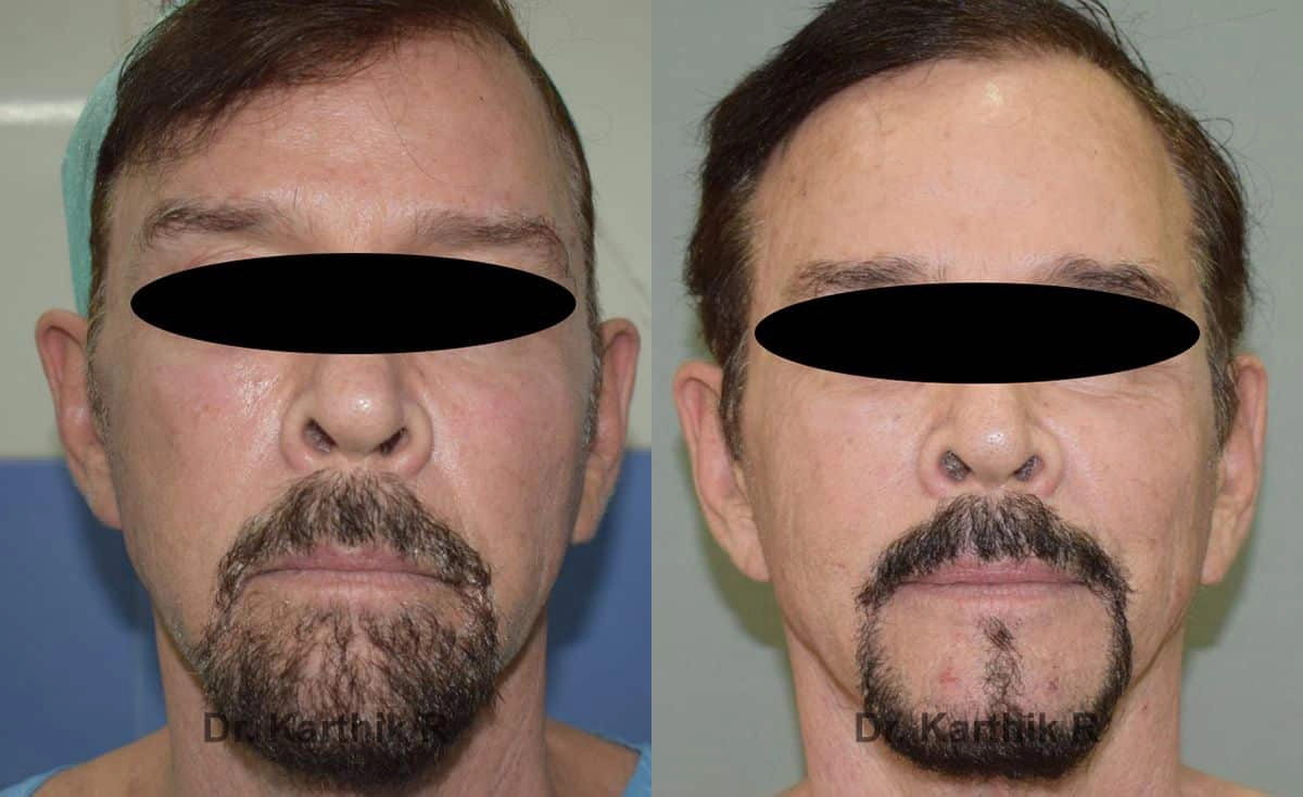 fat graft fat fill fat transfer before and after photo by chennai plastic surgery in india