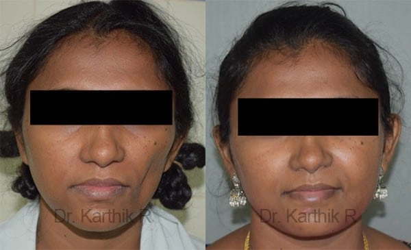 fat graft fat fill fat transfer before and after photo by chennai plastic surgery in india