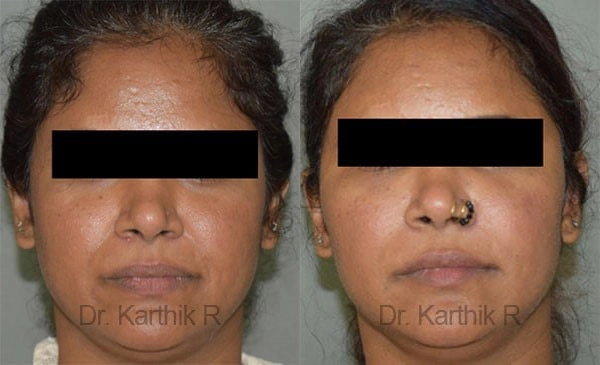 fat graft fat fill fat transfer before and after photo by chennai plastic surgery in india