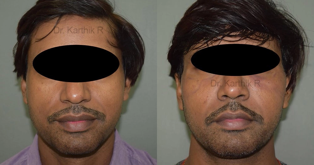 fat graft fat fill fat transfer before and after photo by chennai plastic surgery in india