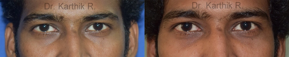 under eye fat fill before and after photo by chennai plastic surgery in india