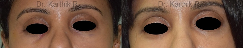 under eye fat fill before and after photo by chennai plastic surgery in india