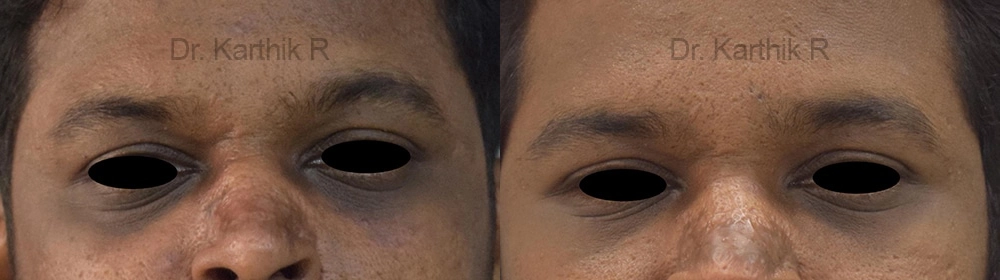 under eye fat fill before and after photo by chennai plastic surgery in india