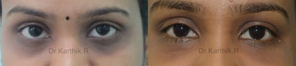 under eye fat fill before and after photo by chennai plastic surgery in india