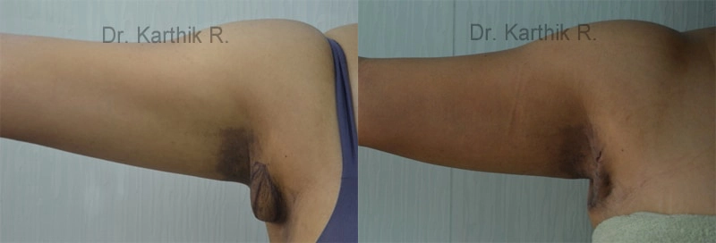 axillary tail of breast before and after photo by chennai plastic surgery in india
