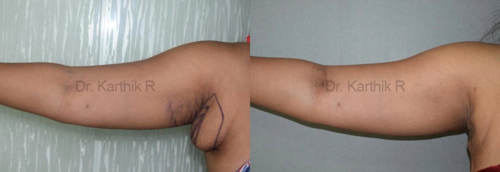 axillary tail of breast before and after photo by chennai plastic surgery in india