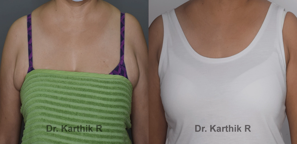 axillary tail of breast before and after photo by chennai plastic surgery in india