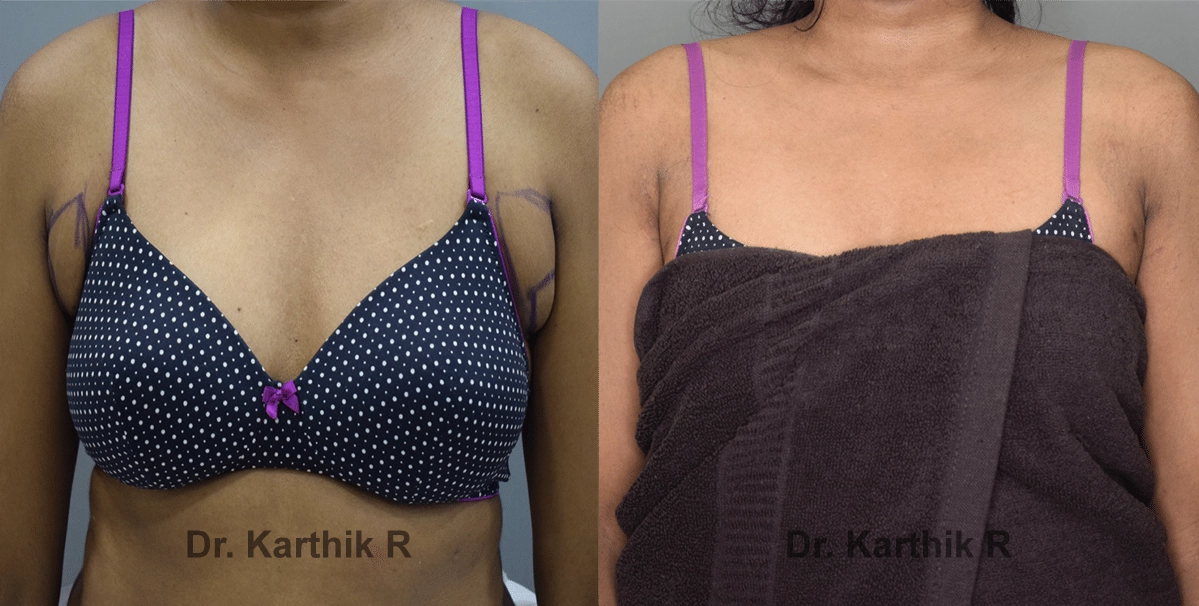 axillary tail of breast before and after photo by chennai plastic surgery in india