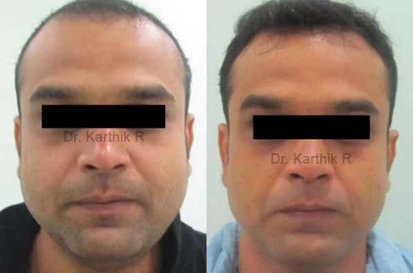 exilis before and after photo by chennai plastic surgery in india