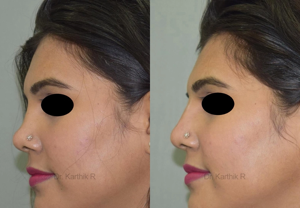 dermal fillers before and after photo by chennai plastic surgery in india