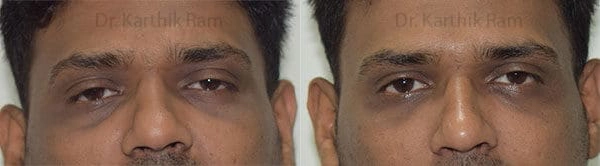 dermal fillers before and after photo by chennai plastic surgery in india