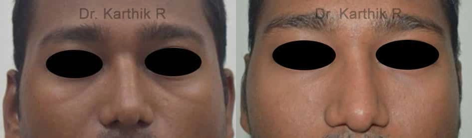 dermal fillers before and after photo by chennai plastic surgery in india
