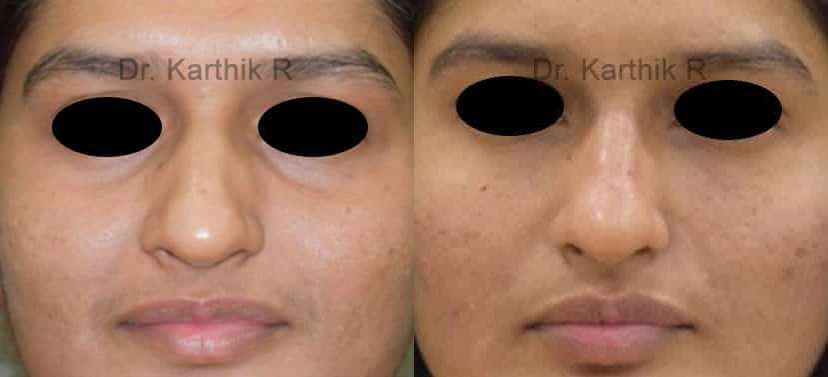 dermal fillers before and after photo by chennai plastic surgery in india