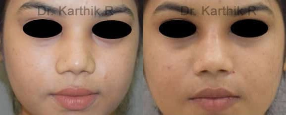 dermal fillers before and after photo by chennai plastic surgery in india