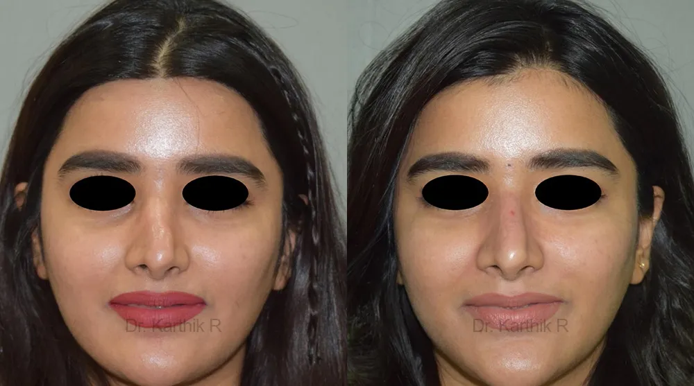dermal fillers before and after photo by chennai plastic surgery in india