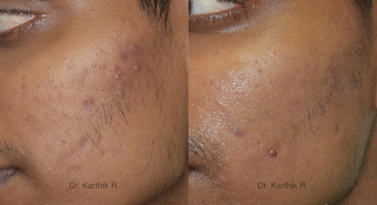 chemical peels microdermabrasion before and after photo by chennai plastic surgery in india